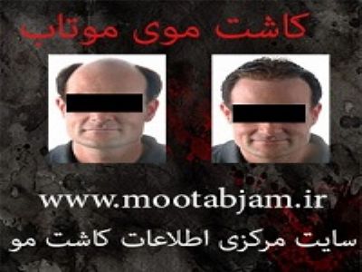 جلوگیری از ریزش مو (کاشت و ترمیم موی موتاب )